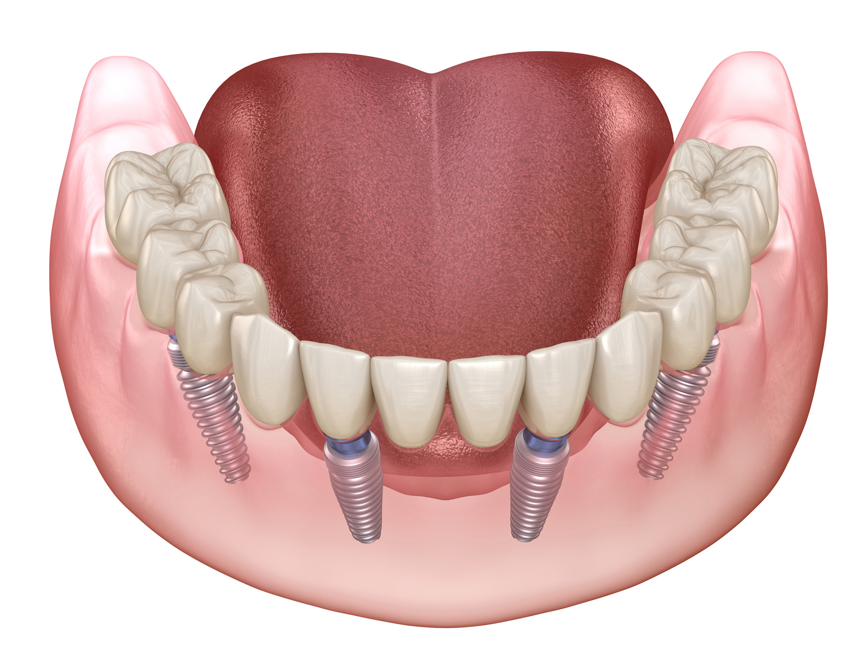 consultation-dentiste-traitement-edente-complet-amiens-1024x683